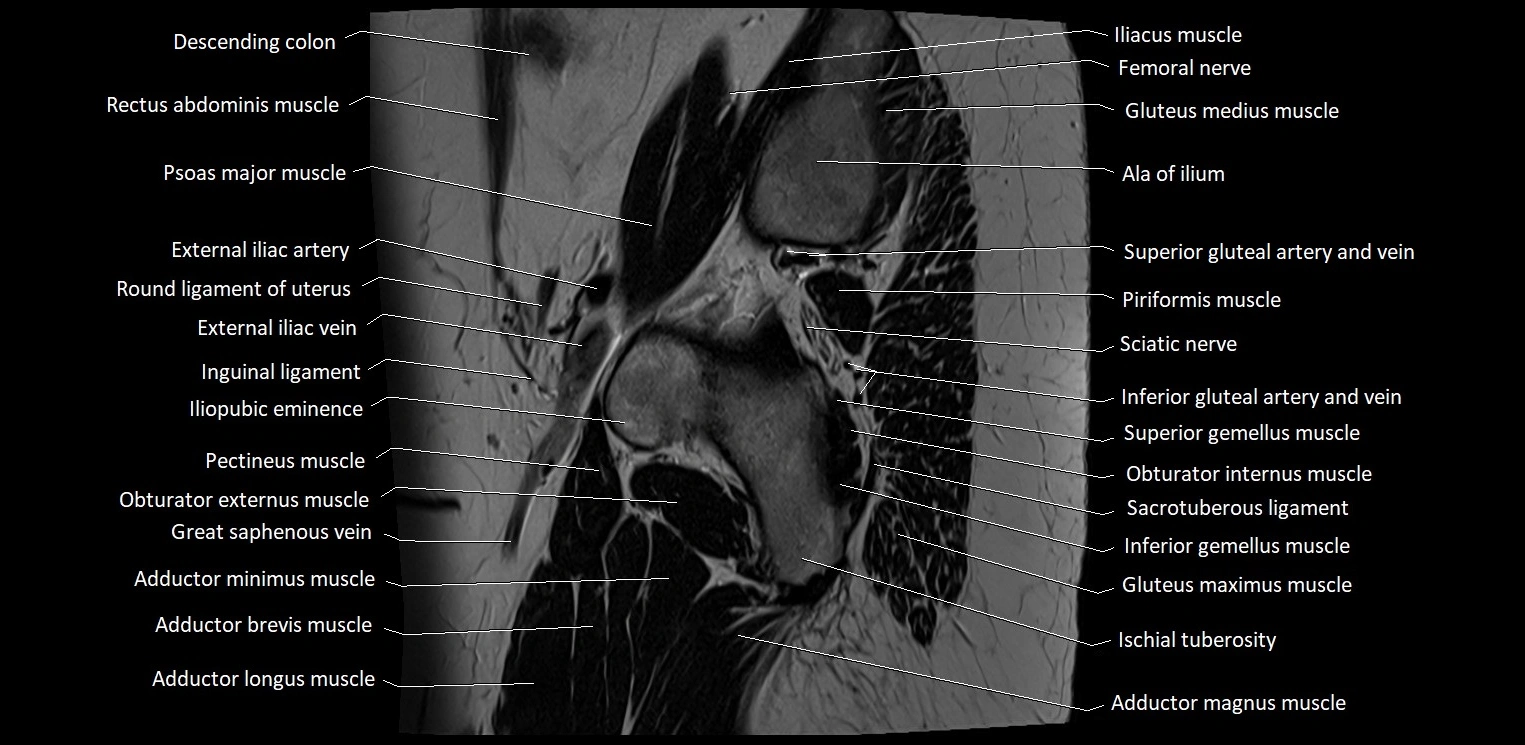 Sagittal cross sectional anatomy of female pelvis (MRI 3T) image 40.webp